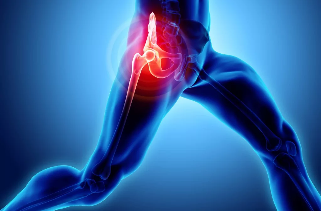Arthrose Hanche à Paris 16 - Coxarthrose - Dr Leymarie